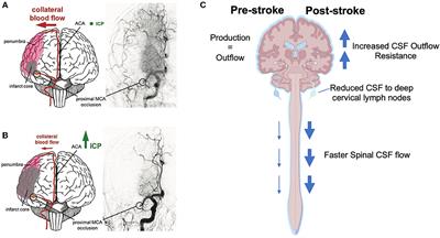 Intracranial pressure elevation post-stroke: Mechanisms and consequences